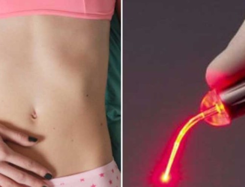 Can Lasers Improve Your Sex Life?